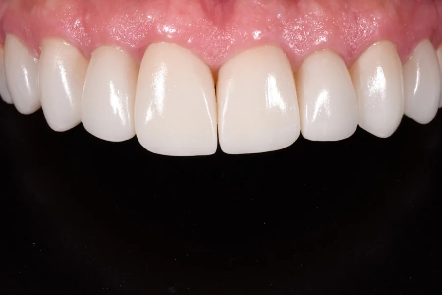 Estética Dental