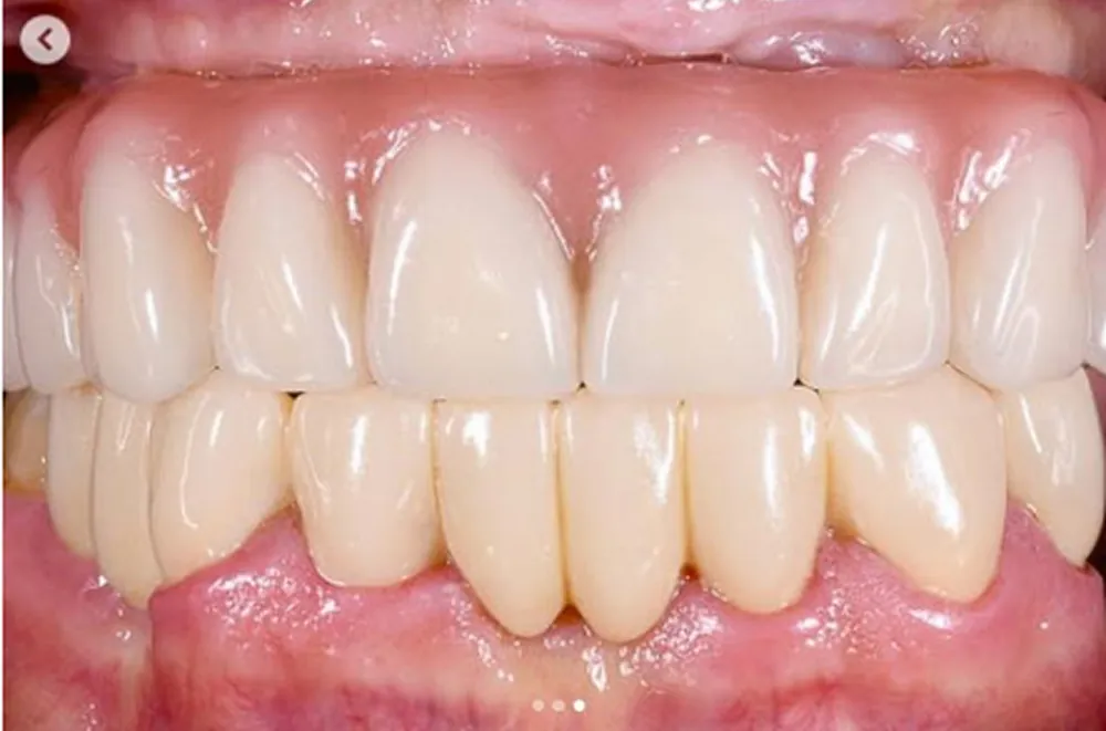 Implantes Dentales