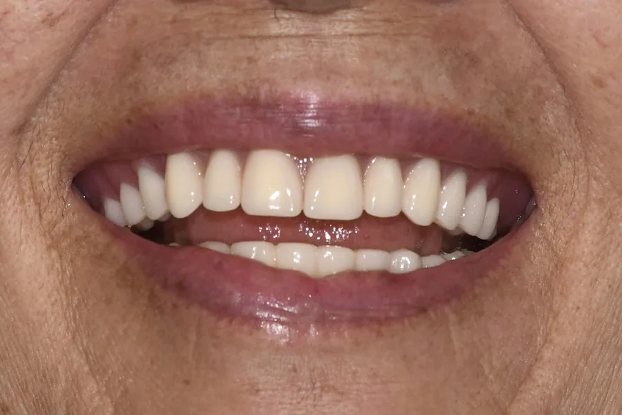 Rehabilitación Oral