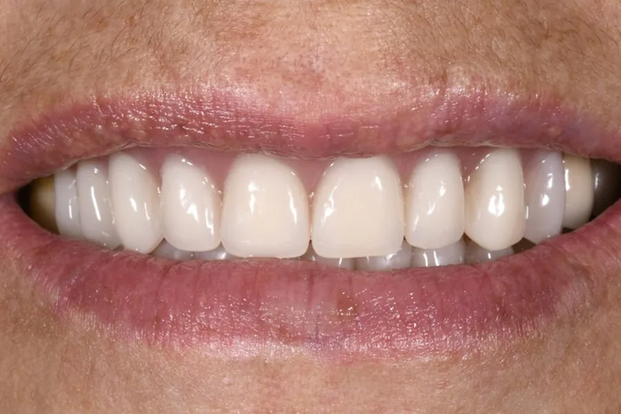 Caso de Rehabilitación Oral en Armonía Dental Group