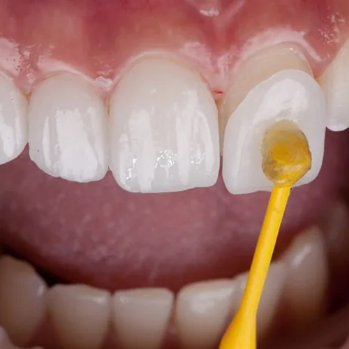 Blanqueamiento Dental