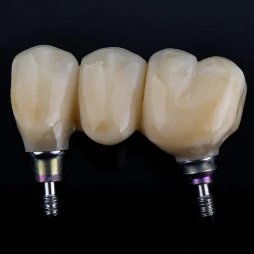 Coronas y Puentes sobre Implantes