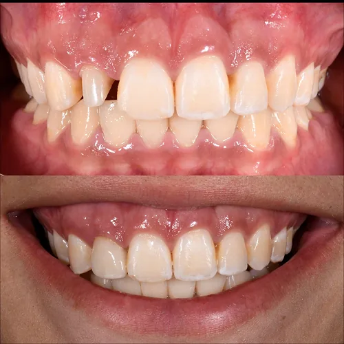 Gingivoplastia Estética