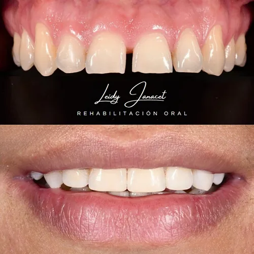 Implantes Dentales Unitarios