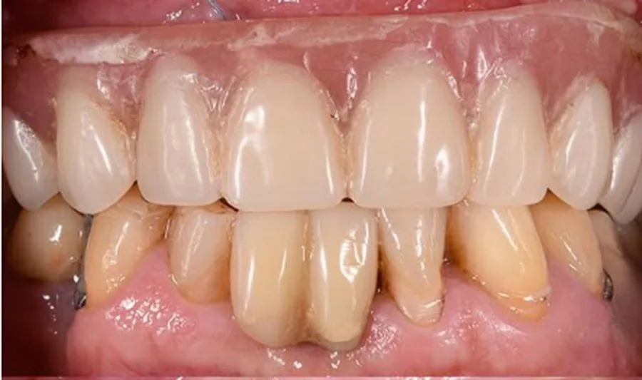 Cuidado Periodontal