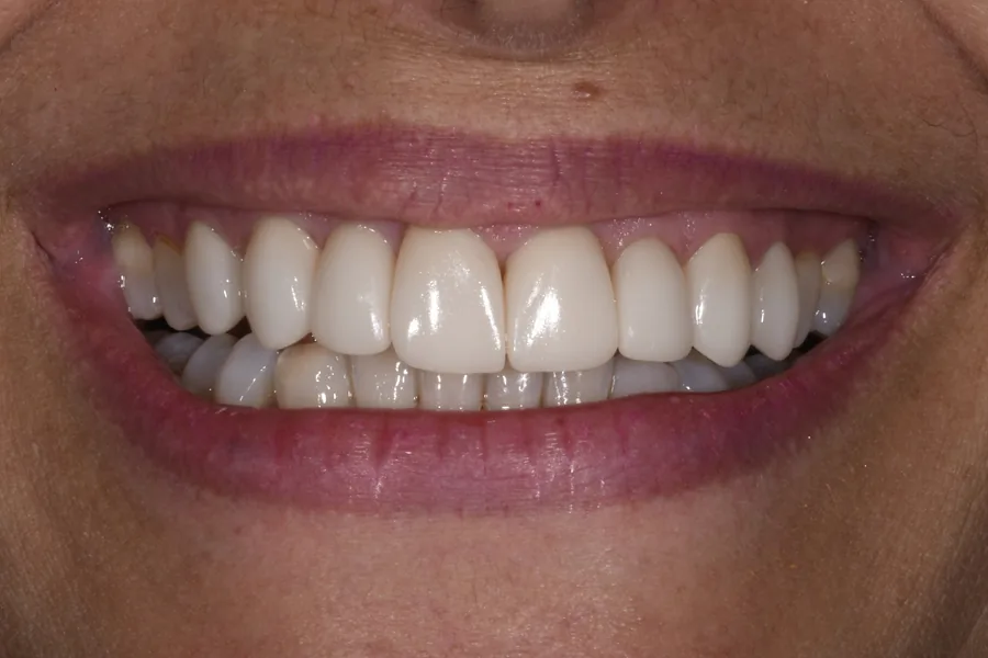 Selladores Dentales